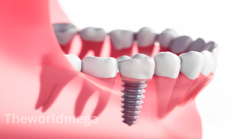How much does a dental implant cost without insurance?